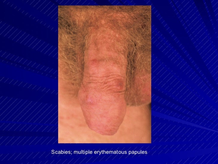 Pictures Of Scabies On Penis